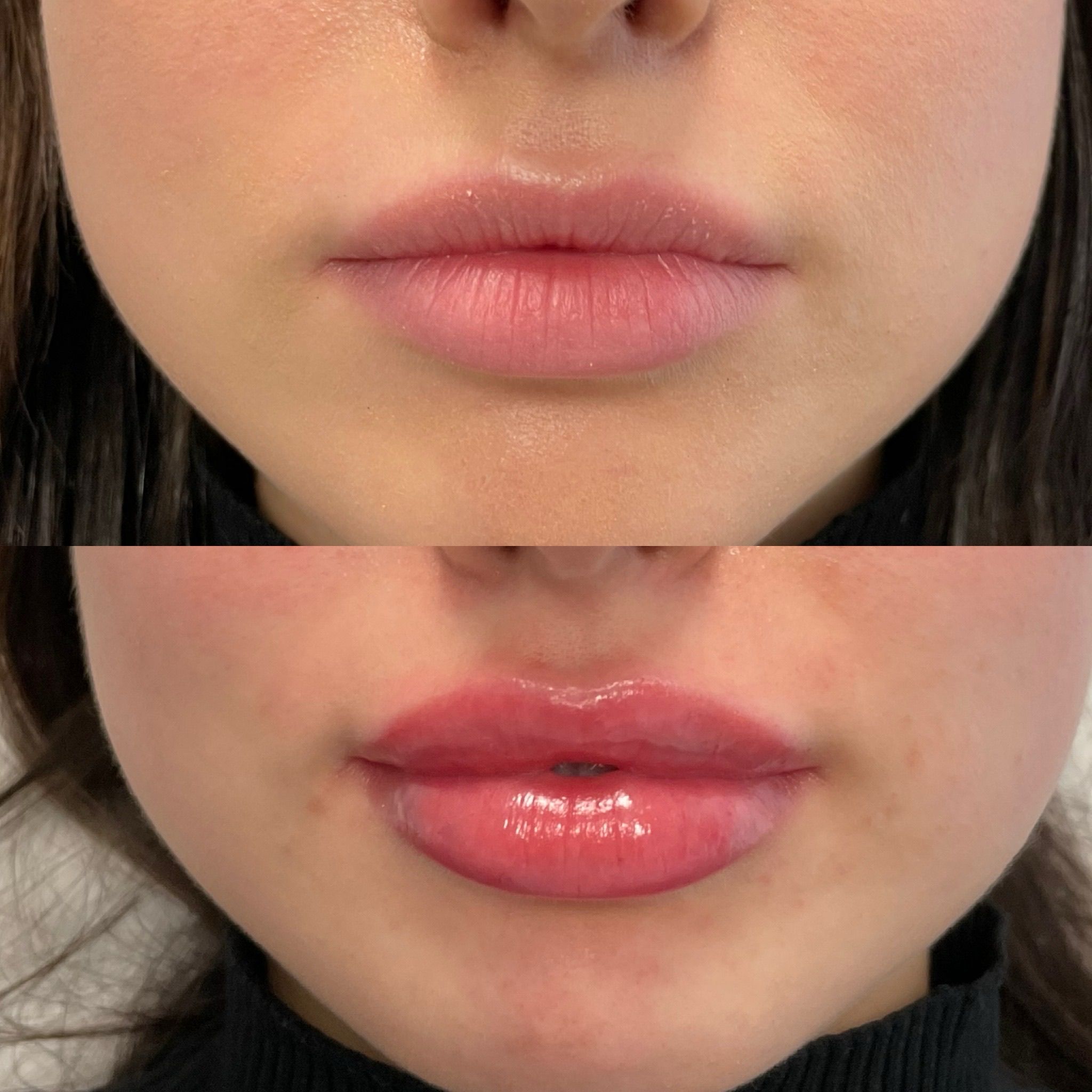 Lip Filler London - Elite Lip Enhancement & Modern Lip Augmentation