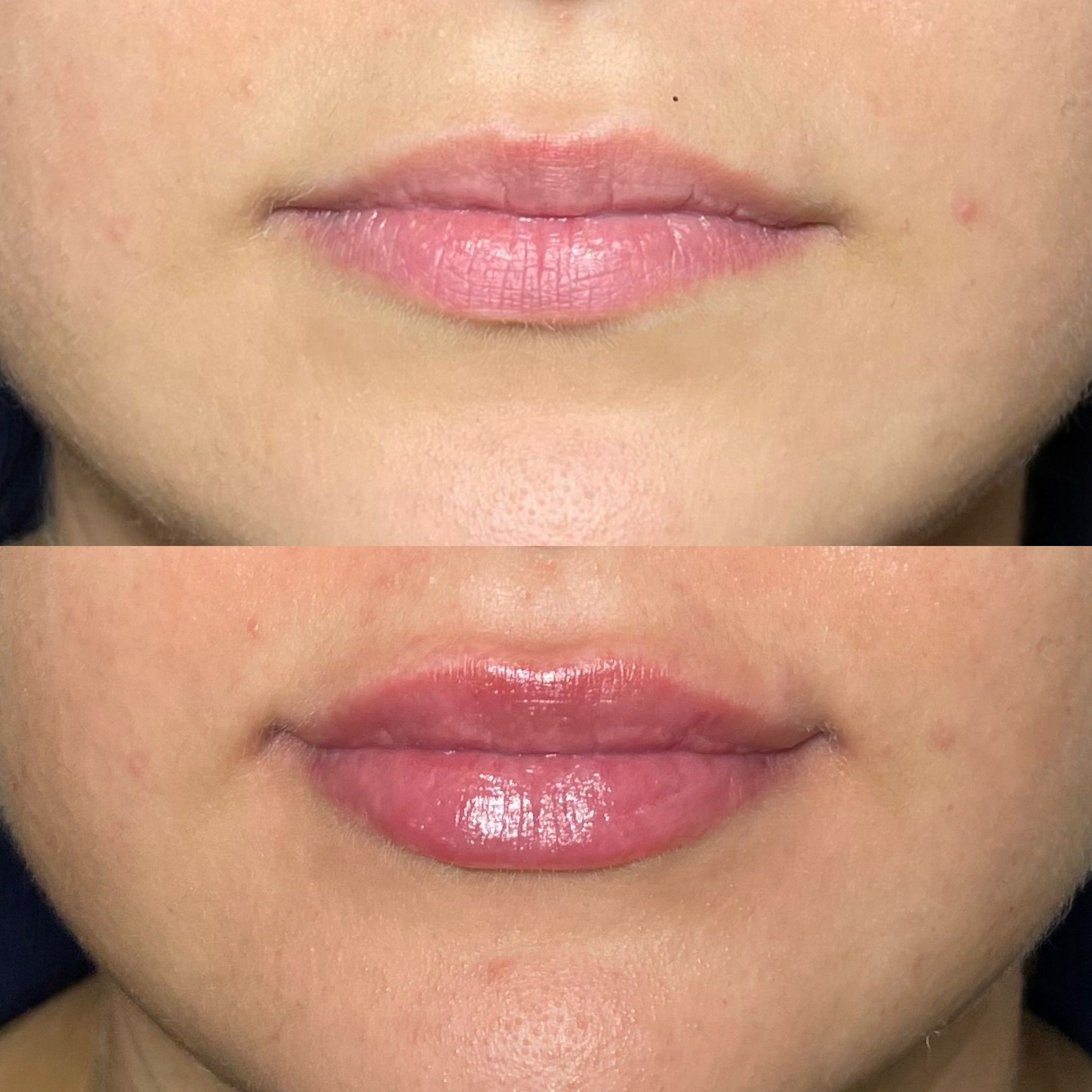 Lip Filler London - Elite Lip Enhancement & Modern Lip Augmentation