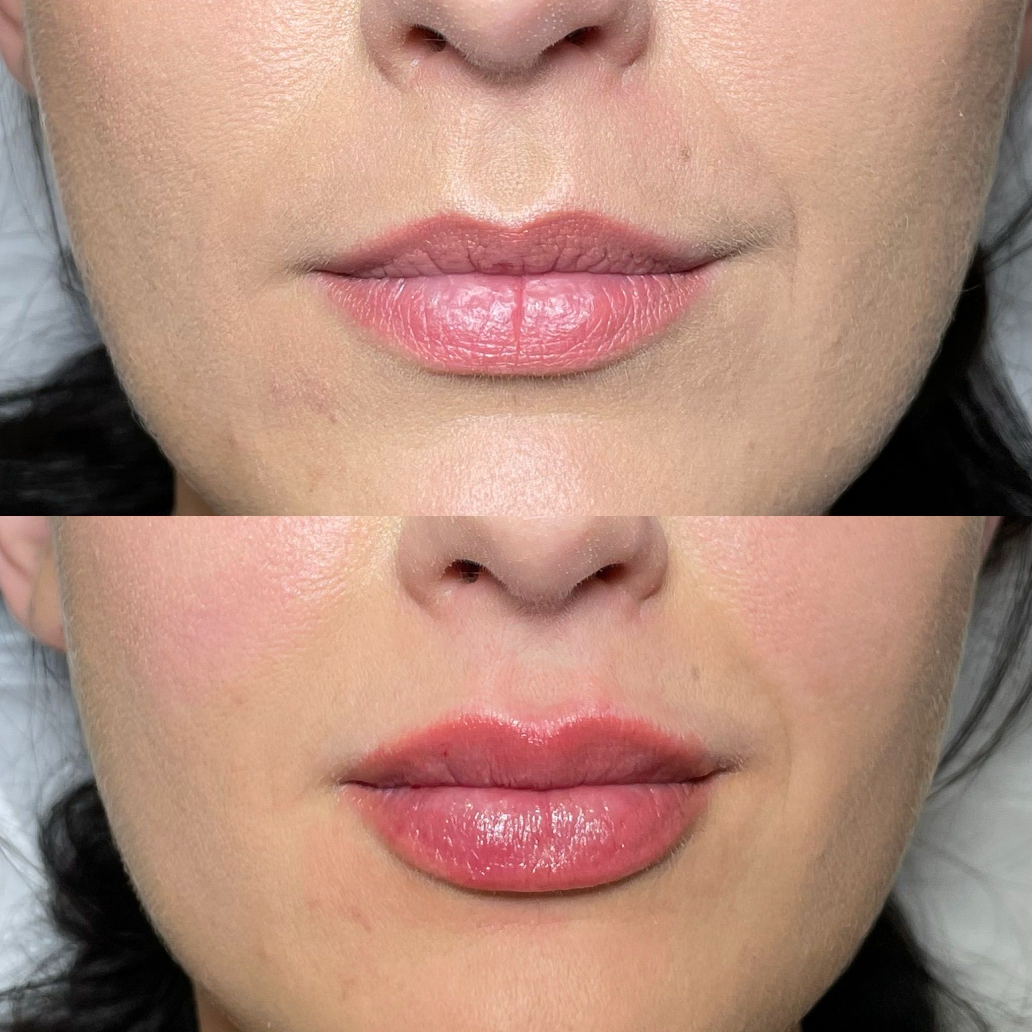 Lip Filler London - Elite Lip Enhancement & Modern Lip Augmentation