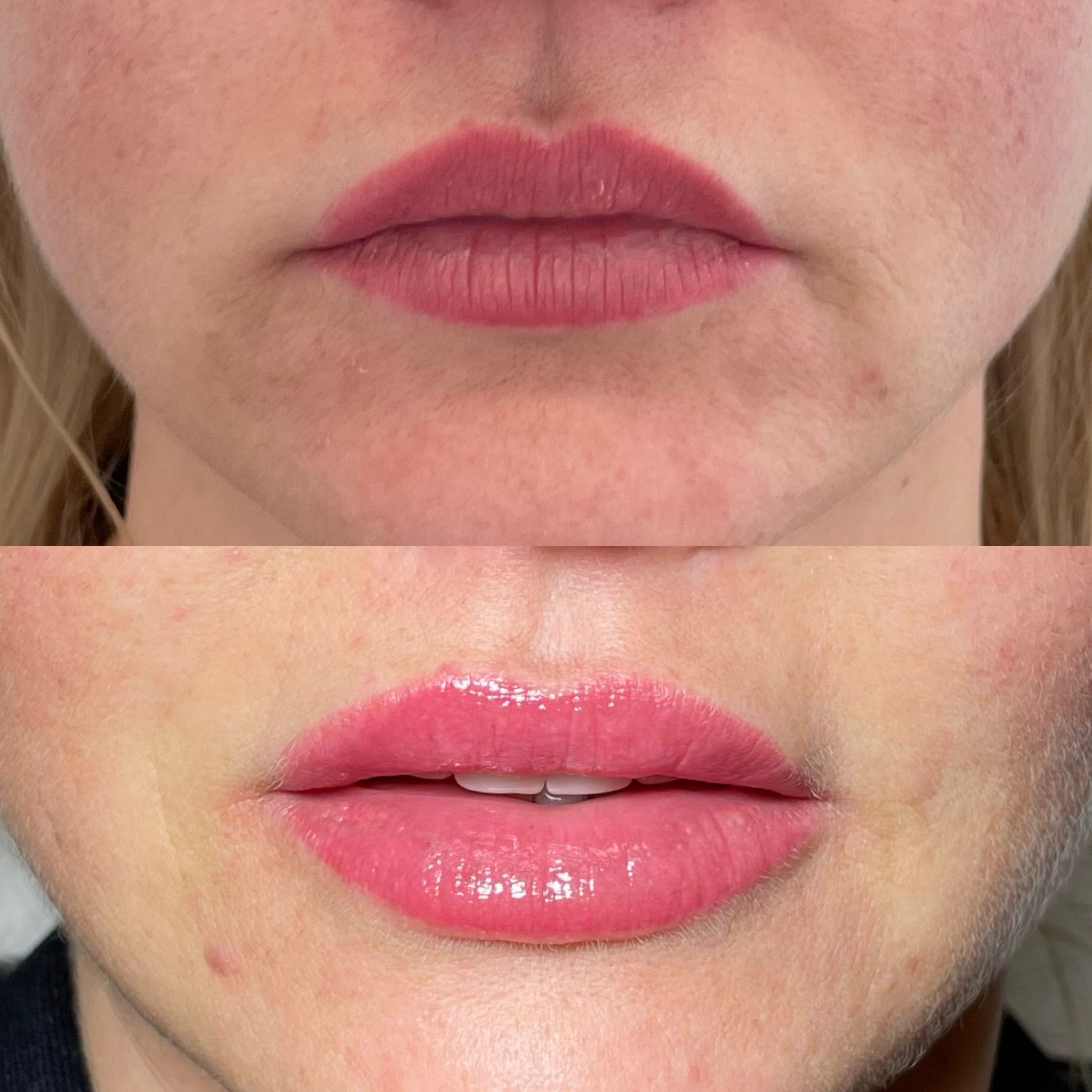 Lip Filler London – Elite Lip Enhancement & Modern Lip Augmentation